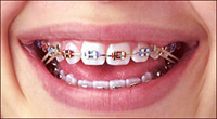 Braces with Rubber Bands